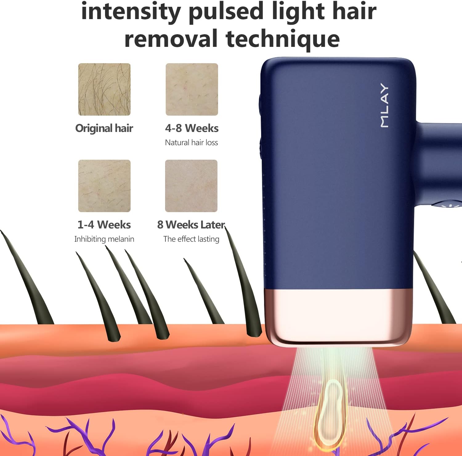 Mlay T14 Laser Epilator IPL Hair Remover Machine Ice Cooling Home Use Depilador for Women Replaceable Laser Hair Removal Device