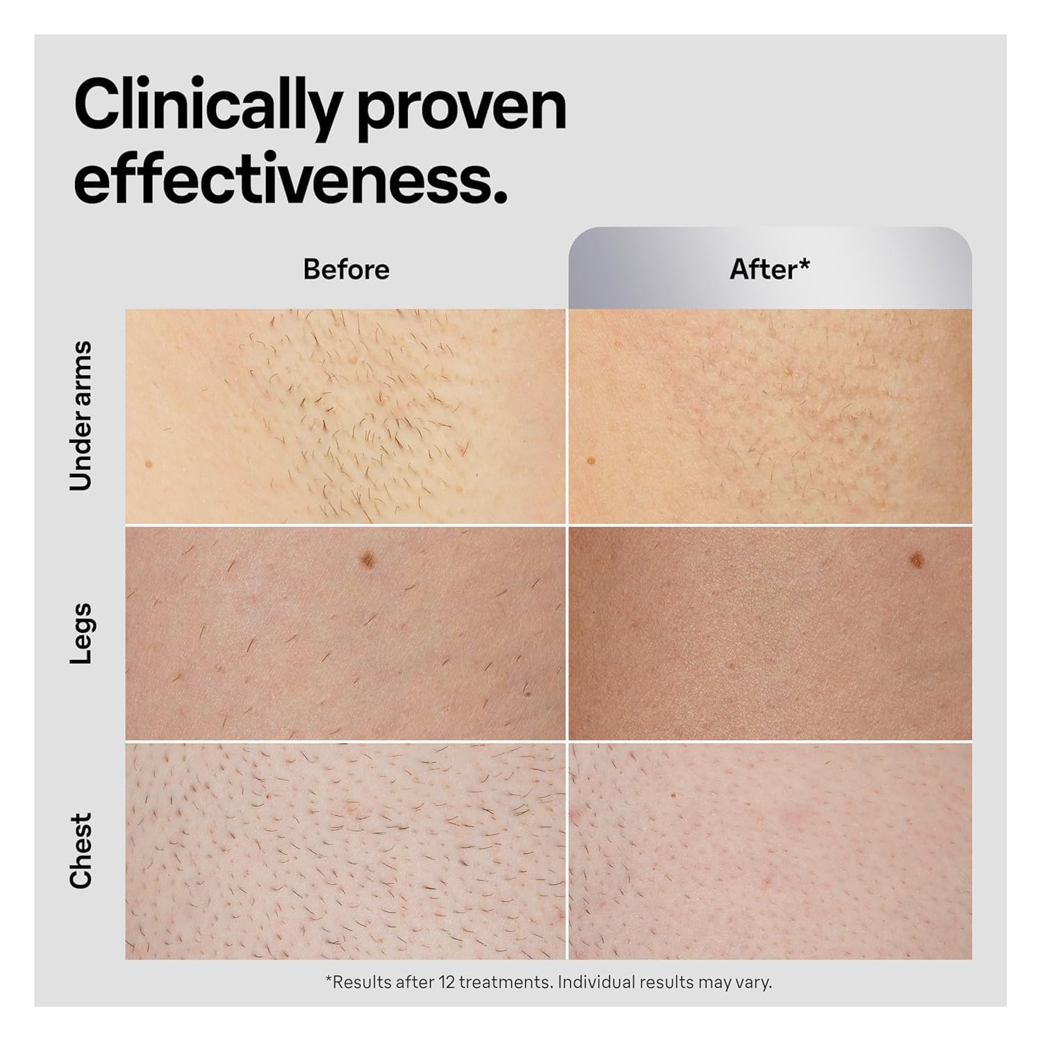 Lumora IPL Pro 5 – Long-Lasting Hair Removal at Home