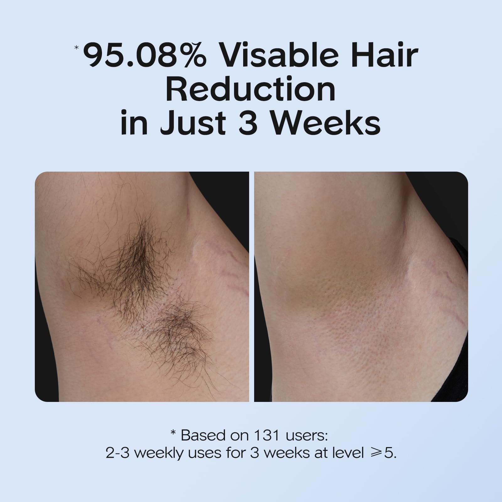 Lumora IceFlash IPL – Painless Hair Removal with Cooling