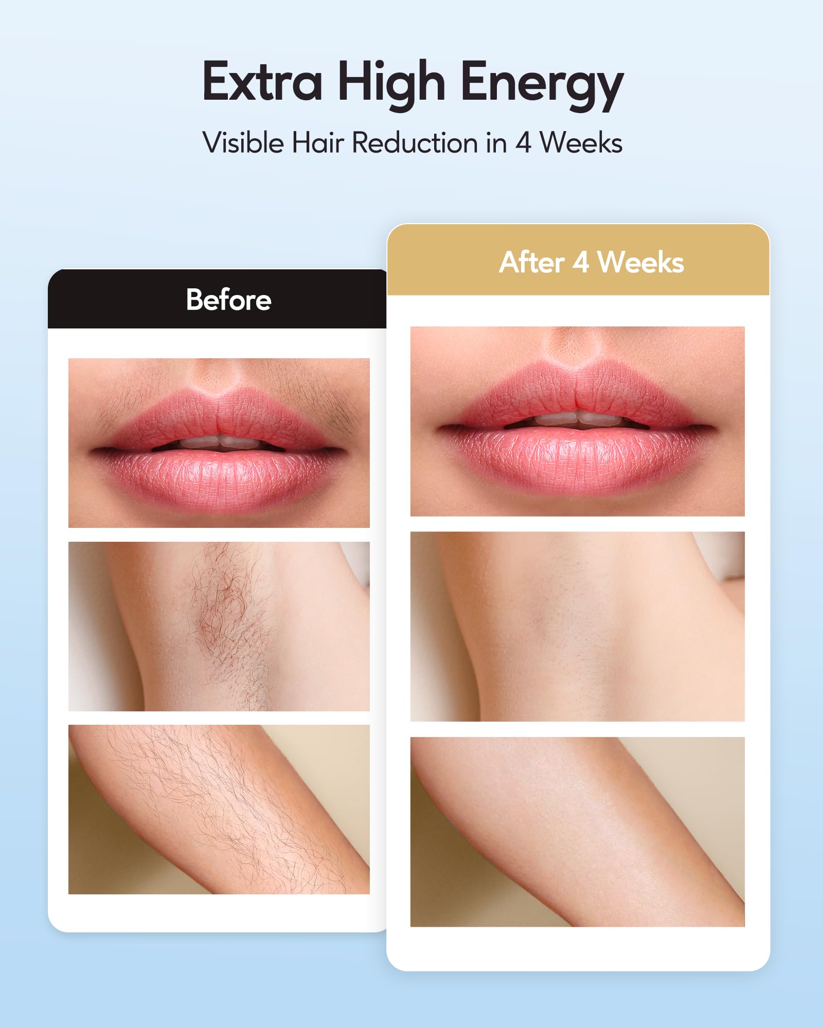 Lumora IceFlash IPL – Painless Hair Removal with Cooling
